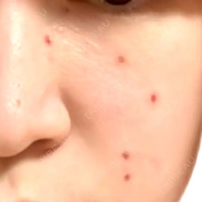 ほくろ・いぼ除去レーザー（肌） Fellez Clinic【フェルズクリニック】 DAY 7 メイン用