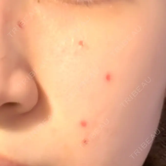 ほくろ・いぼ除去レーザー（肌） Fellez Clinic【フェルズクリニック】 DAY 7 メイン用