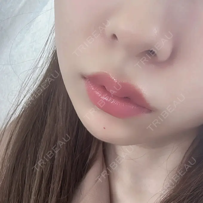 ヒアルロン酸注入（あご） / ボトックス（エラ・小顔） / ヒアルロン酸注入（唇） / ボトックス（人中） / ピコレーザートーニング（美白・肝斑） THE FIRST CLINIC 多摩センター院 AFTER メイン用