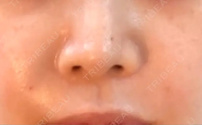 肌ヒアルロン酸注入（たるみ・シワ改善） / ヒアルロン酸注入（鼻翼基部） ブルームクリニック（BLOOM CLINIC） DAY 137 メイン用