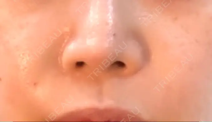 肌ヒアルロン酸注入（たるみ・シワ改善） / ヒアルロン酸注入（鼻翼基部） ブルームクリニック（BLOOM CLINIC） AFTER メイン用