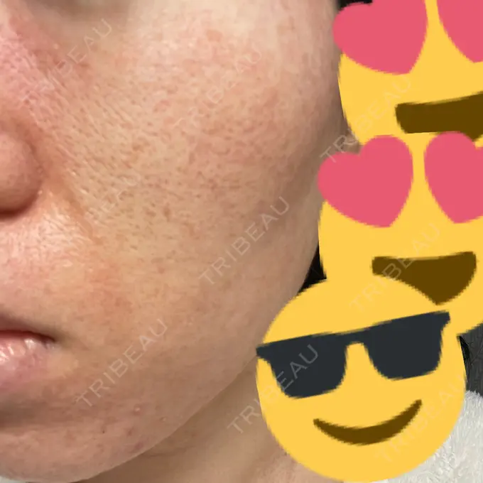 イオン導入 / ニードルRF（ポテンツァなど） オラクル美容皮膚科 名古屋院 DAY 1 メイン用