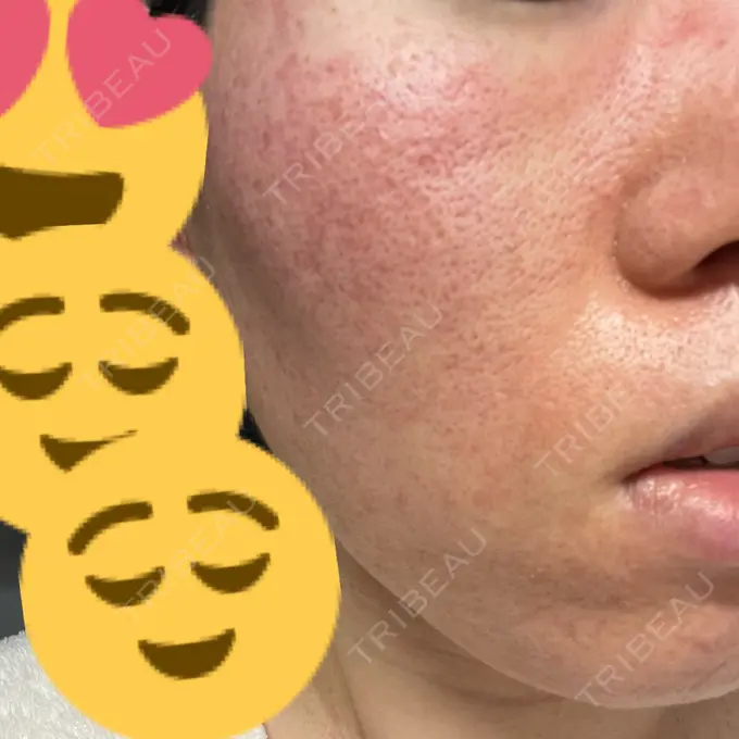 イオン導入 / ニードルRF（ポテンツァなど） オラクル美容皮膚科 名古屋院 DAY 1 メイン用