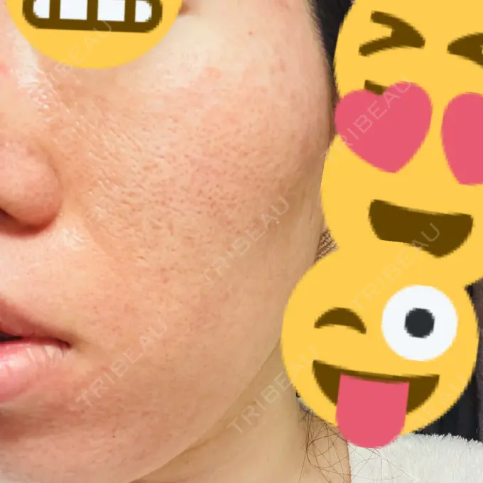 イオン導入 / ニードルRF（ポテンツァなど） オラクル美容皮膚科 名古屋院 AFTER メイン用