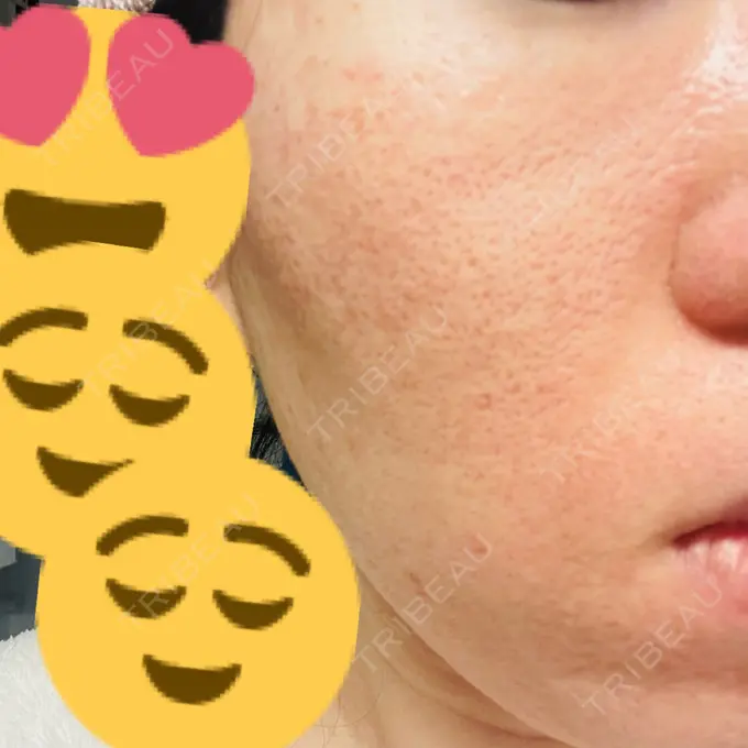 イオン導入 / ニードルRF（ポテンツァなど） オラクル美容皮膚科 名古屋院 DAY 10 メイン用