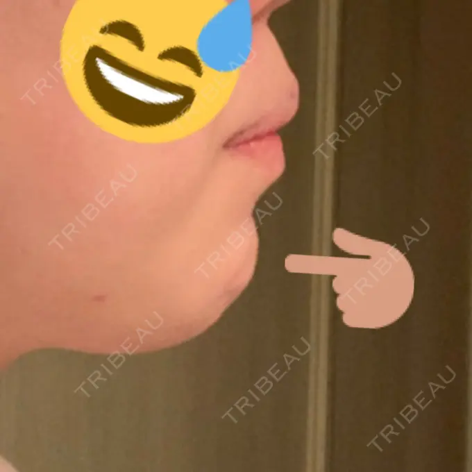 あごプロテーゼ / ヒアルロン酸注入（鼻） WOM CLINIC GINZA （ワム クリニック ギンザ） AFTER メイン用