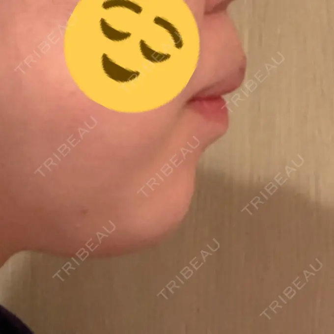 あごプロテーゼ / ヒアルロン酸注入（鼻） WOM CLINIC GINZA （ワム クリニック ギンザ） DAY 98 メイン用