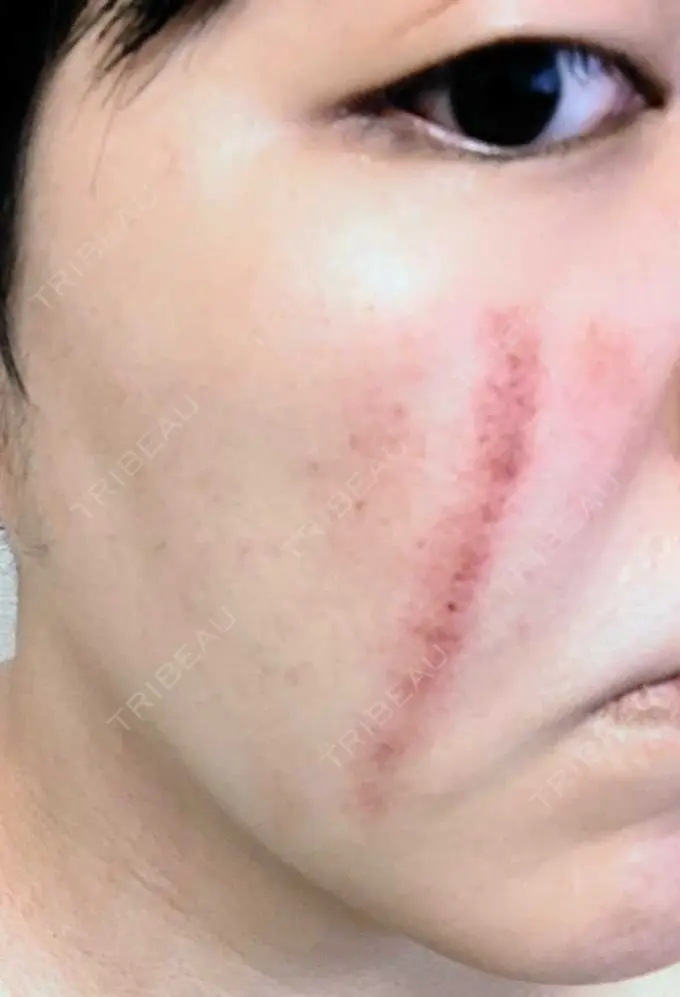 傷跡修正 / ダーマペン 品川美容外科 町田院 DAY 2 メイン用