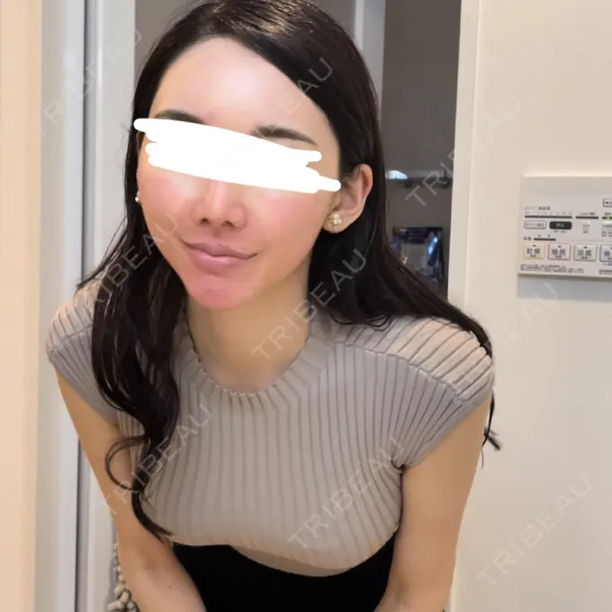 ピーリング（ニキビ・毛穴） ルラ美容クリニック 神戸院 DAY 1 メイン用