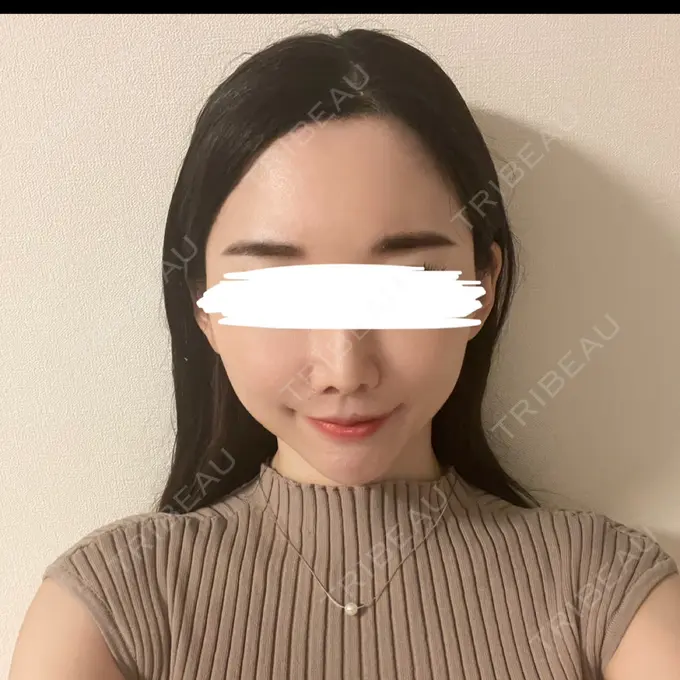 ピーリング（ニキビ・毛穴） ルラ美容クリニック 神戸院 AFTER メイン用