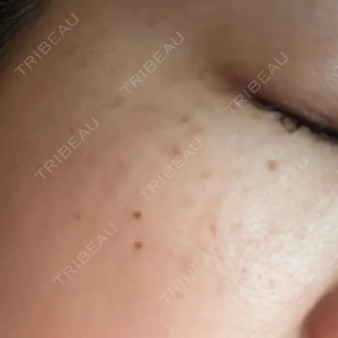 光治療（フォトフェイシャルなど） MKクリニック 日本橋院 DAY 1 メイン用