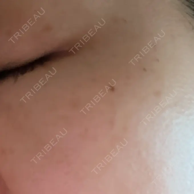 光治療（フォトフェイシャルなど） MKクリニック 日本橋院 DAY 1 メイン用