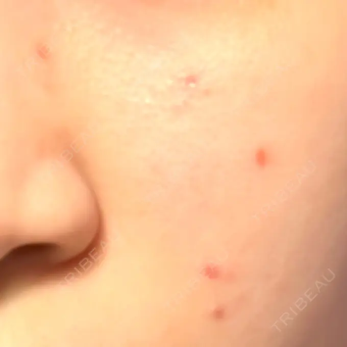 ほくろ・いぼ除去レーザー（肌） Fellez Clinic【フェルズクリニック】 DAY 11 メイン用