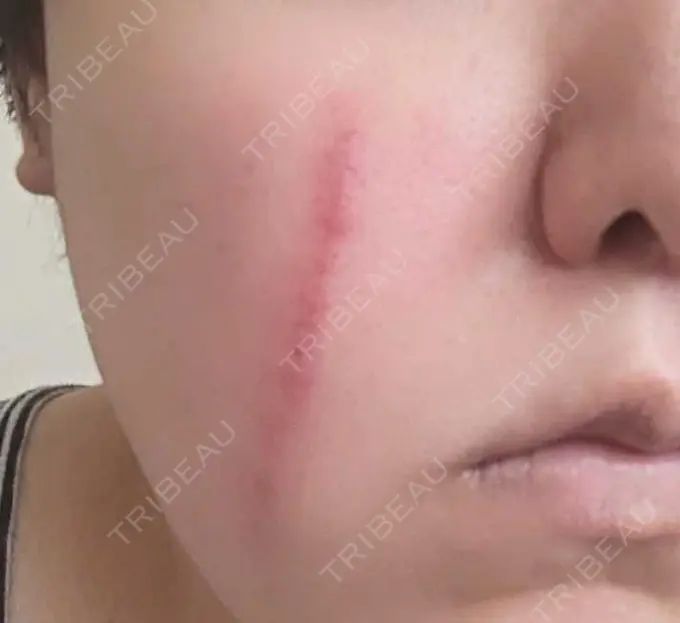 傷跡修正 / ダーマペン 品川美容外科 町田院 DAY 3 メイン用