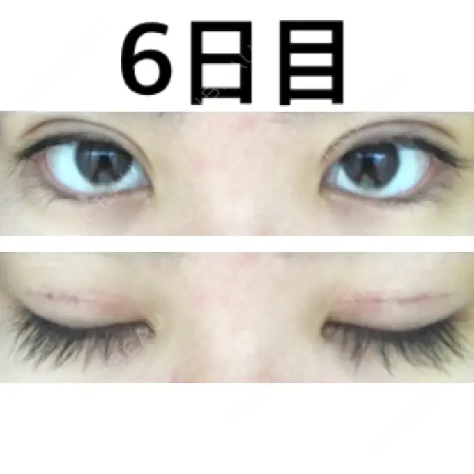 二重切開 みずほクリニック DAY 6 メイン用