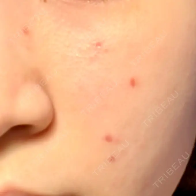 ほくろ・いぼ除去レーザー（肌） Fellez Clinic【フェルズクリニック】 DAY 12 メイン用