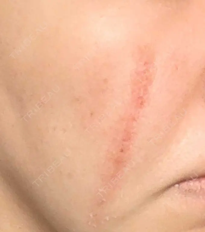 傷跡修正 / ダーマペン 品川美容外科 町田院 DAY 4 メイン用