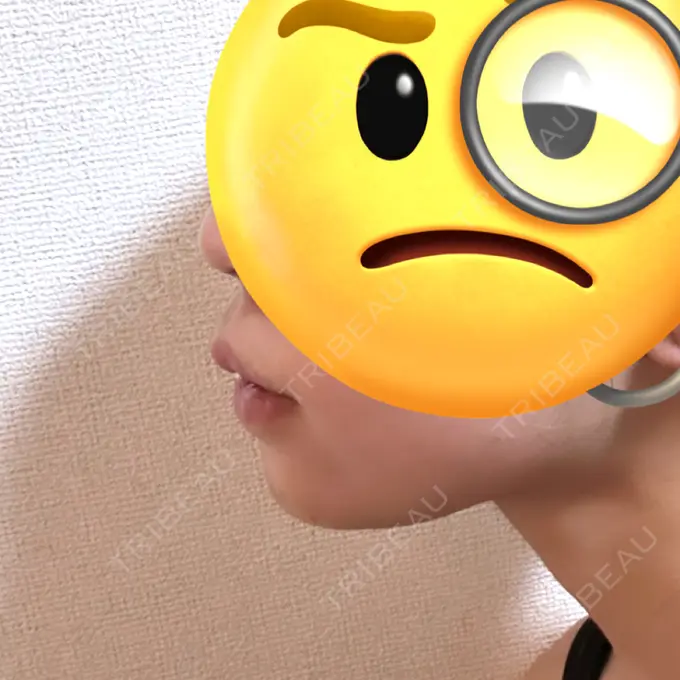 あごプロテーゼ / その他（輪郭） WOM CLINIC GINZA （ワム クリニック ギンザ） DAY 7 メイン用