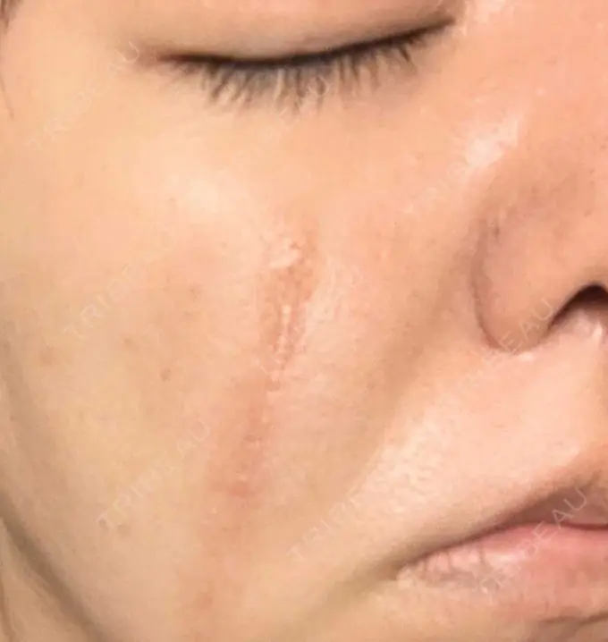 傷跡修正 / ダーマペン 品川美容外科 町田院 DAY 5 メイン用