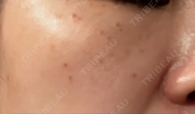 光治療（フォトフェイシャルなど） MKクリニック 日本橋院 AFTER メイン用