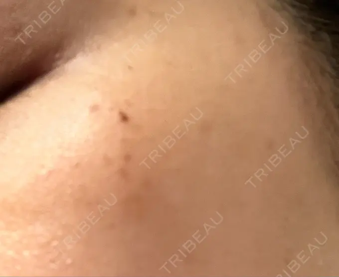 光治療（フォトフェイシャルなど） MKクリニック 日本橋院 DAY 33 メイン用