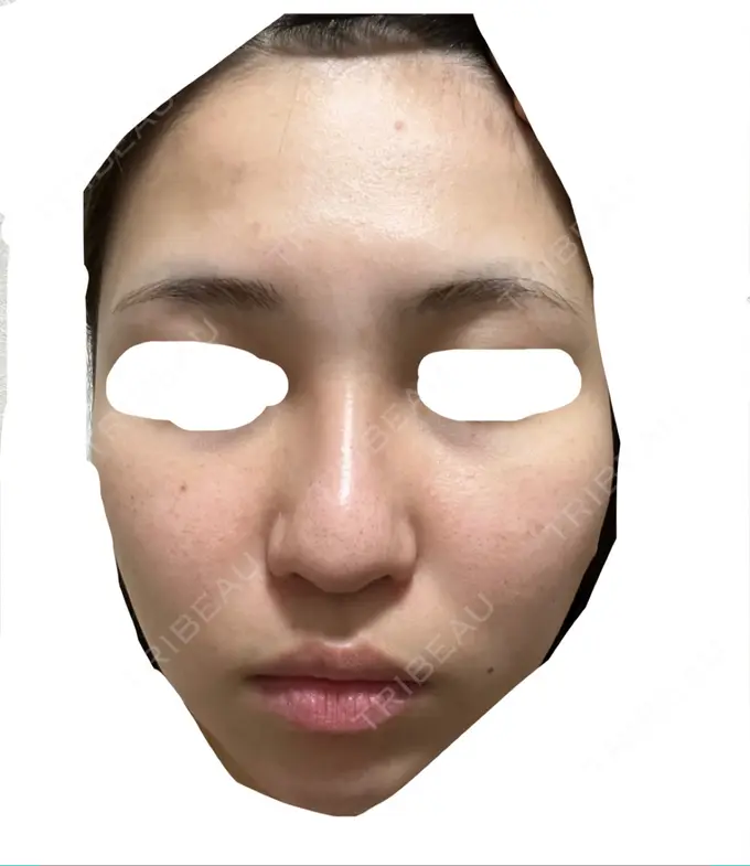 エレクトロポレーション / 毛穴洗浄（ハイドラフェイシャルなど） / 光治療（フォトフェイシャルなど） X CLINIC 大阪院 AFTER メイン用