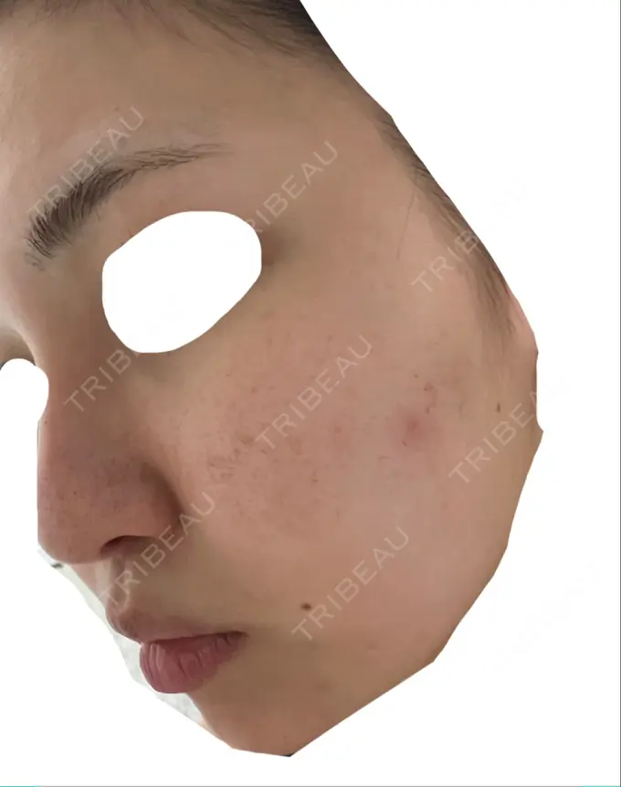 エレクトロポレーション / 毛穴洗浄（ハイドラフェイシャルなど） / 光治療（フォトフェイシャルなど） X CLINIC 大阪院 DAY 4 メイン用