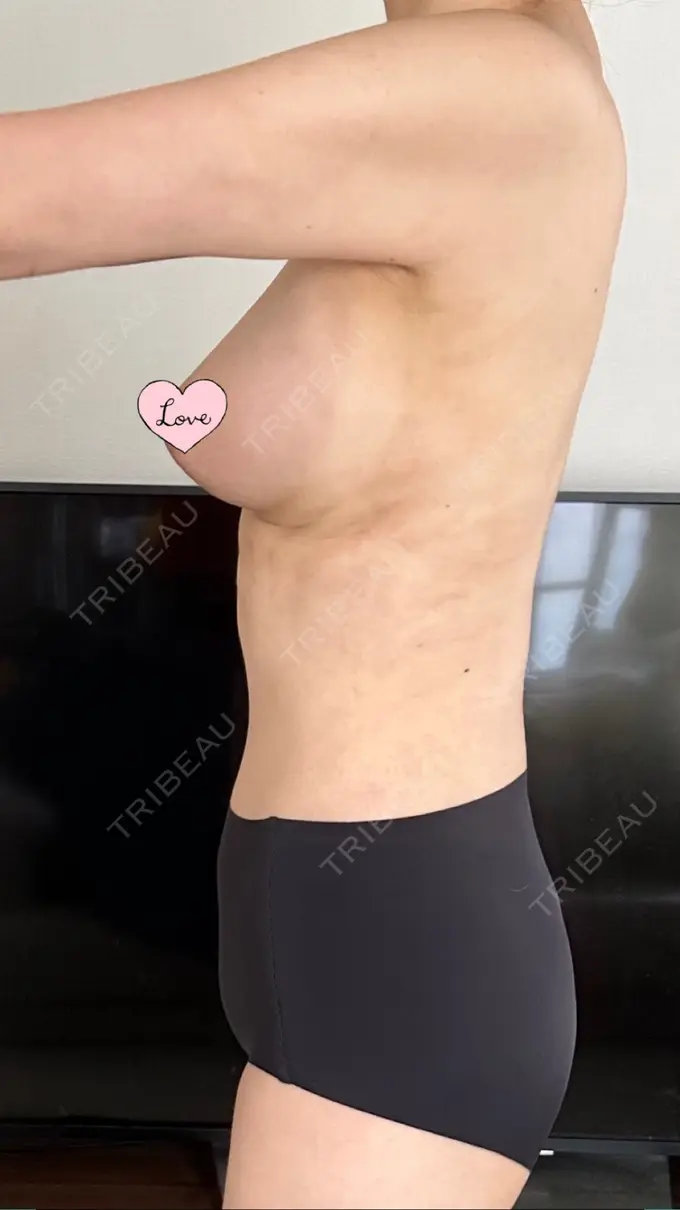 脂肪吸引（お腹） / 豊胸（脂肪注入） / 脂肪吸引（腰） / 脂肪吸引（背中） WOM CLINIC GINZA （ワム クリニック ギンザ） DAY 20 メイン用