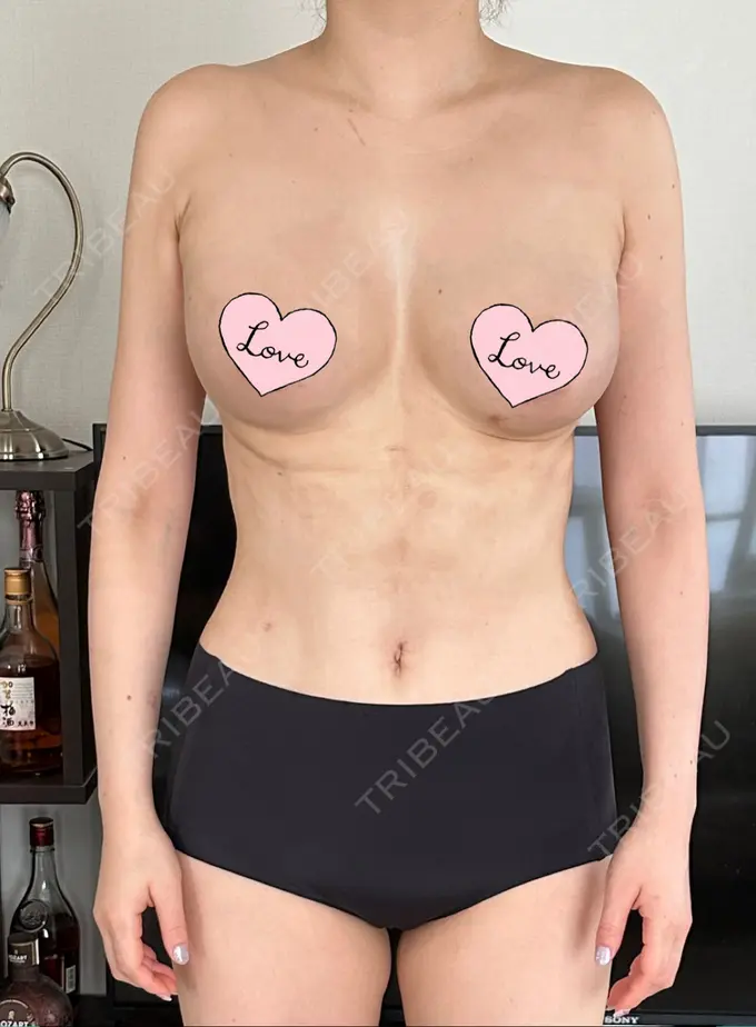 脂肪吸引（お腹） / 豊胸（脂肪注入） / 脂肪吸引（腰） / 脂肪吸引（背中） WOM CLINIC GINZA （ワム クリニック ギンザ） AFTER メイン用