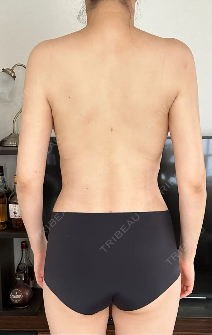 脂肪吸引（お腹） / 豊胸（脂肪注入） / 脂肪吸引（腰） / 脂肪吸引（背中） WOM CLINIC GINZA （ワム クリニック ギンザ） DAY 20 メイン用