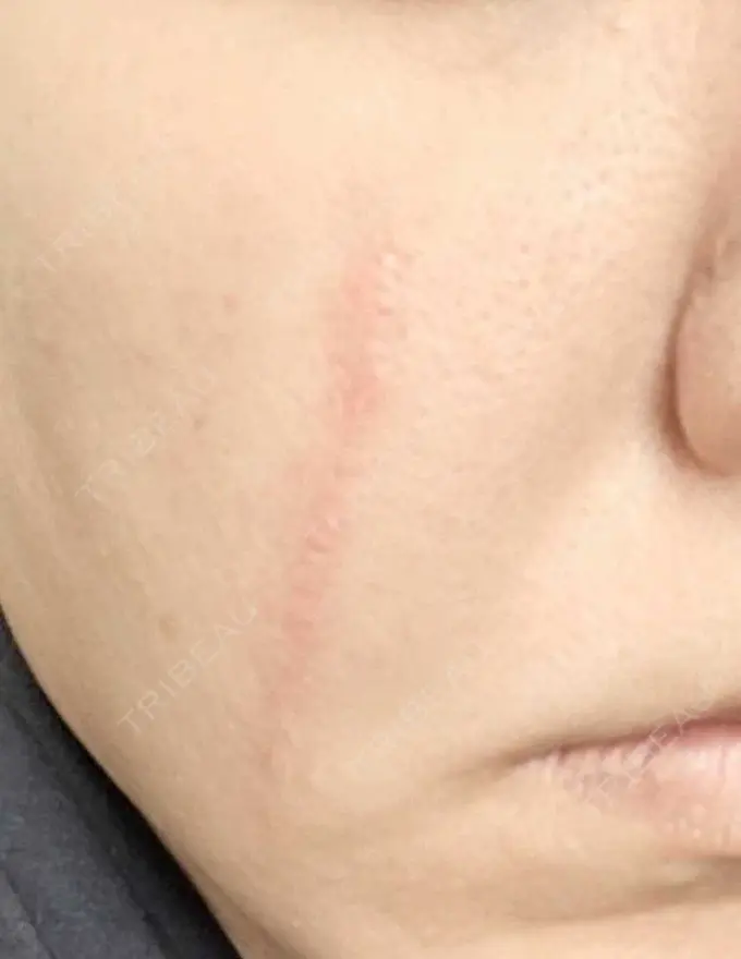 傷跡修正 / ダーマペン 品川美容外科 町田院 DAY 6 メイン用