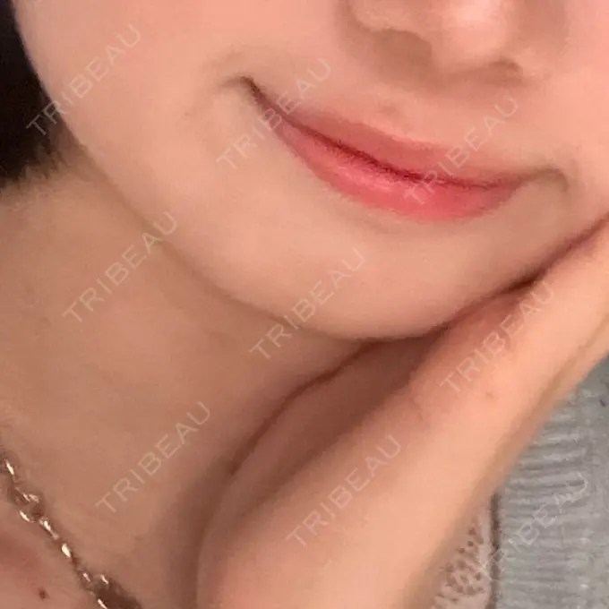 ボトックス（あご） しらゆりメディカルクリニック （旧しらゆりビューティークリニック） DAY 9 メイン用