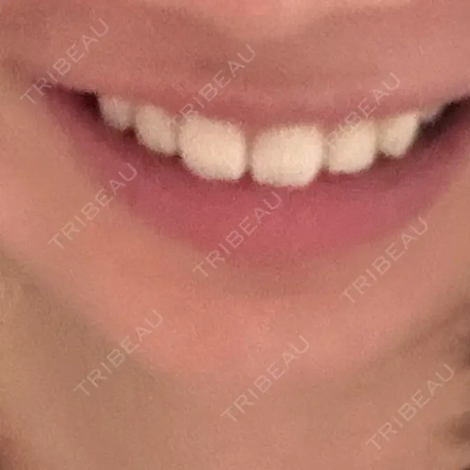 ボトックス（あご） しらゆりメディカルクリニック （旧しらゆりビューティークリニック） AFTER メイン用