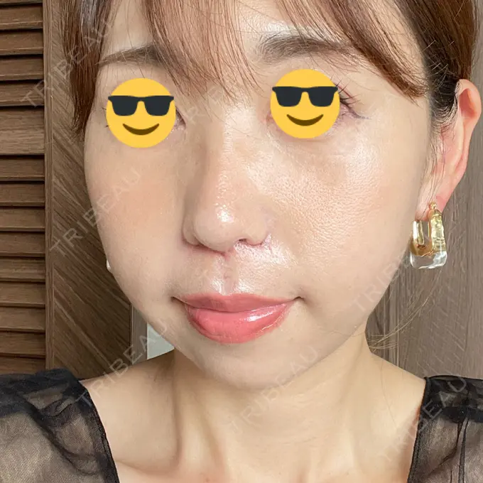 小鼻縮小（切開） / 鼻翼挙上 Otus Clinic 【オータスクリニック】 DAY 30 メイン用