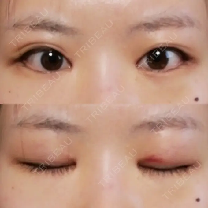 目頭切開 / 目尻切開 / 水光注射（ハリ・美肌） エートップ美容整形外科 DAY 19 メイン用