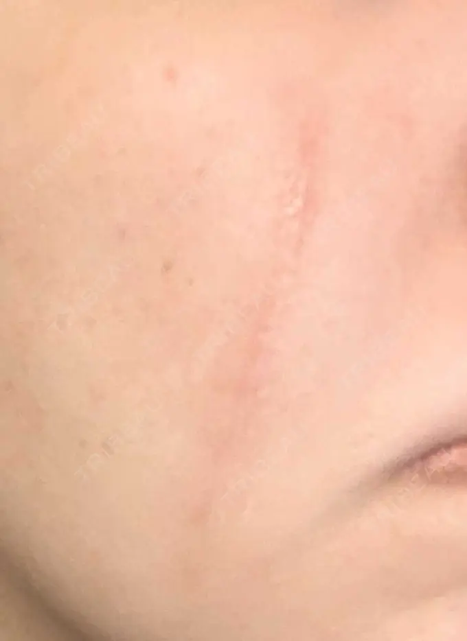 傷跡修正 / ダーマペン 品川美容外科 町田院 DAY 8 メイン用