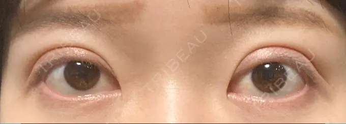 二重切開 / 目元修正 心斎橋コムロ美容外科クリニック DAY 224 メイン用