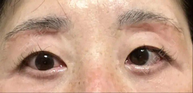 眉下切開 みずほクリニック DAY 71 メイン用