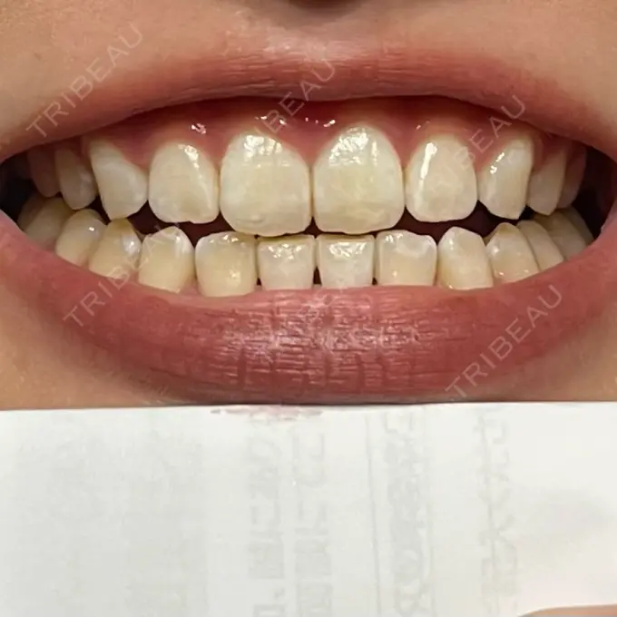 ホワイトニング SK新宿歌舞伎町美容外科・歯科 DAY 0 メイン用