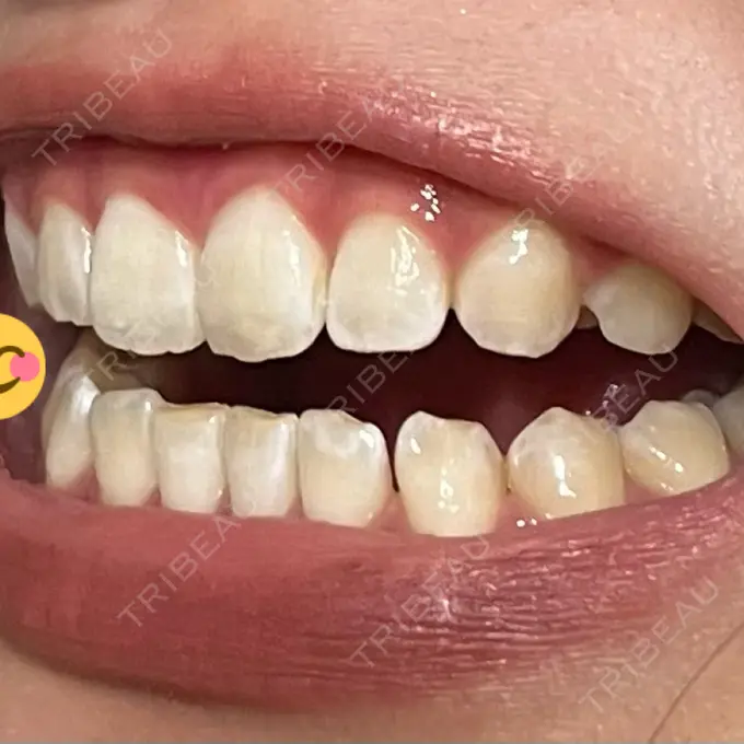 ホワイトニング SK新宿歌舞伎町美容外科・歯科 DAY 0 メイン用