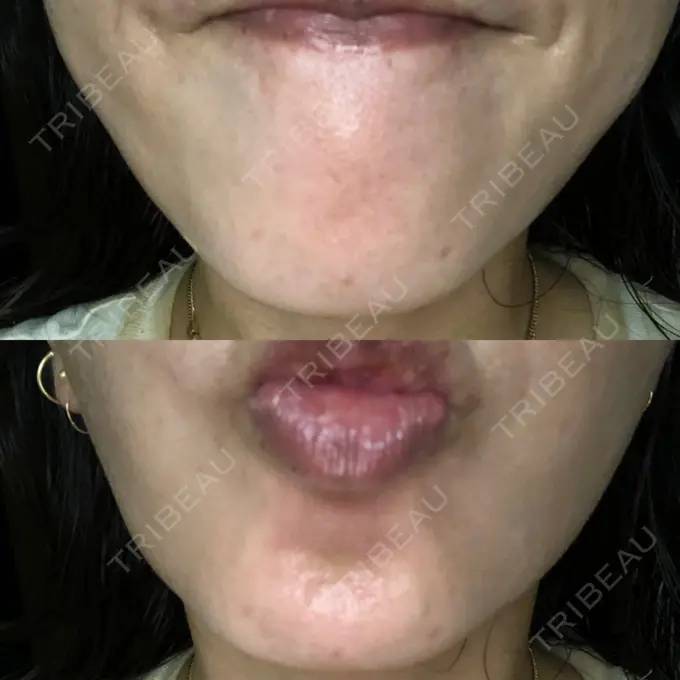 ボトックス（あご） / ボトックス（エラ・小顔） / ボトックス（目尻） TCB東京中央美容外科 新宿三丁目院 AFTER メイン用