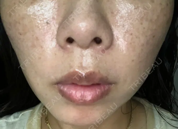 ボトックス（あご） / ボトックス（エラ・小顔） / ボトックス（目尻） TCB東京中央美容外科 新宿三丁目院 DAY 94 メイン用