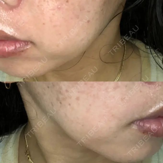 ボトックス（あご） / ボトックス（エラ・小顔） / ボトックス（目尻） TCB東京中央美容外科 新宿三丁目院 DAY 94 メイン用