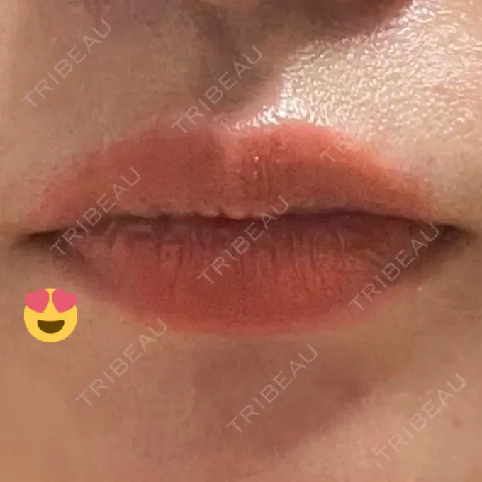 口角挙上 宇都宮竹内クリニック AFTER メイン用