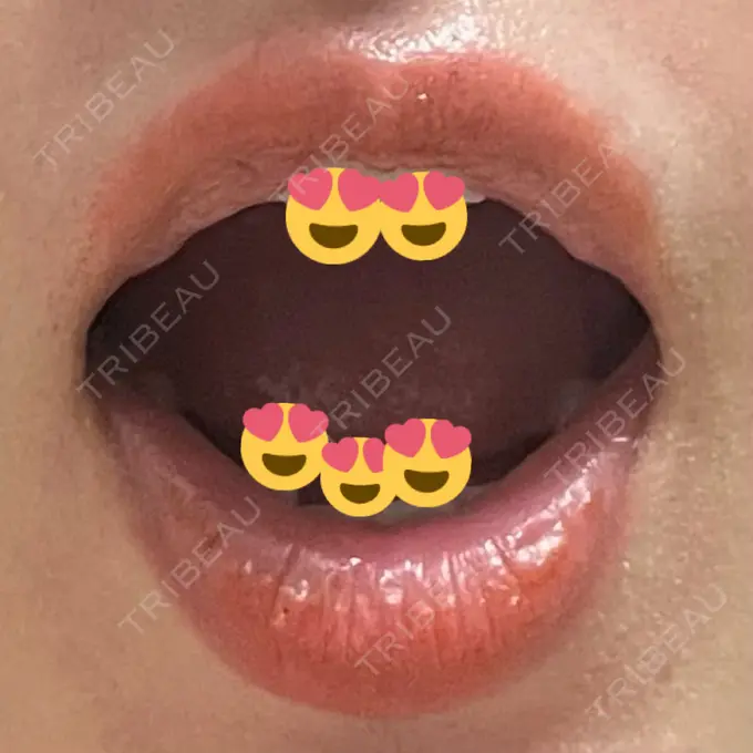 口角挙上 宇都宮竹内クリニック DAY 119 メイン用