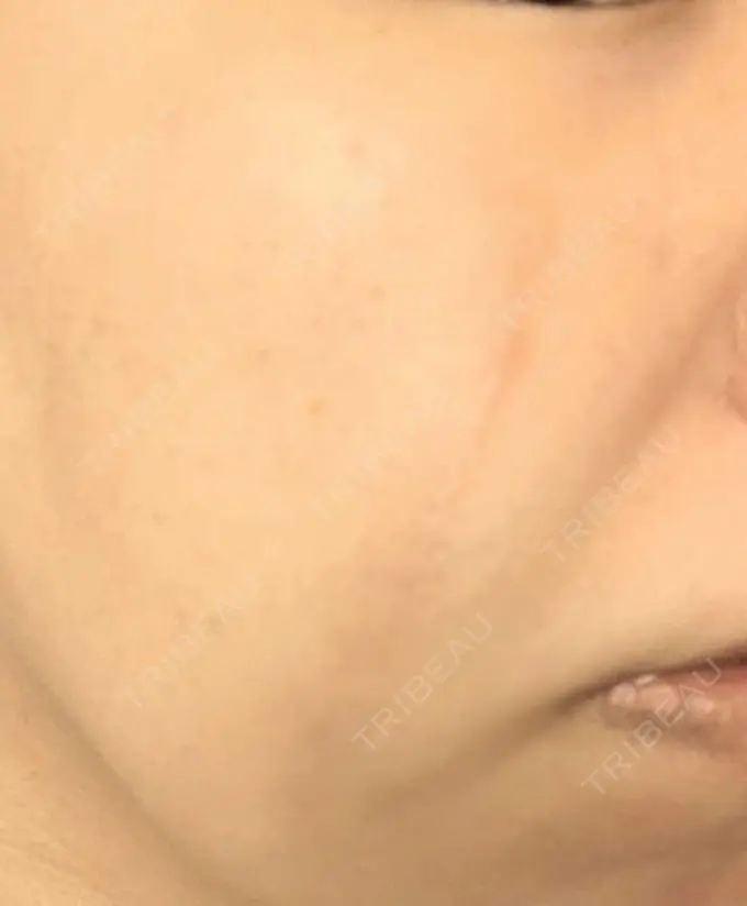 傷跡修正 / ダーマペン 品川美容外科 町田院 AFTER メイン用