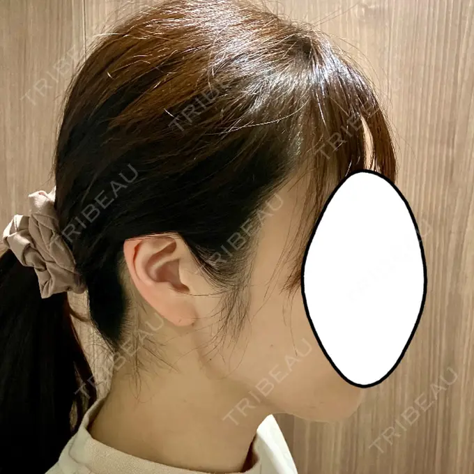 脂肪吸引（顔） / 脂肪吸引（お腹） Mods Clinic（モッズクリニック） 名古屋院 DAY 95 メイン用