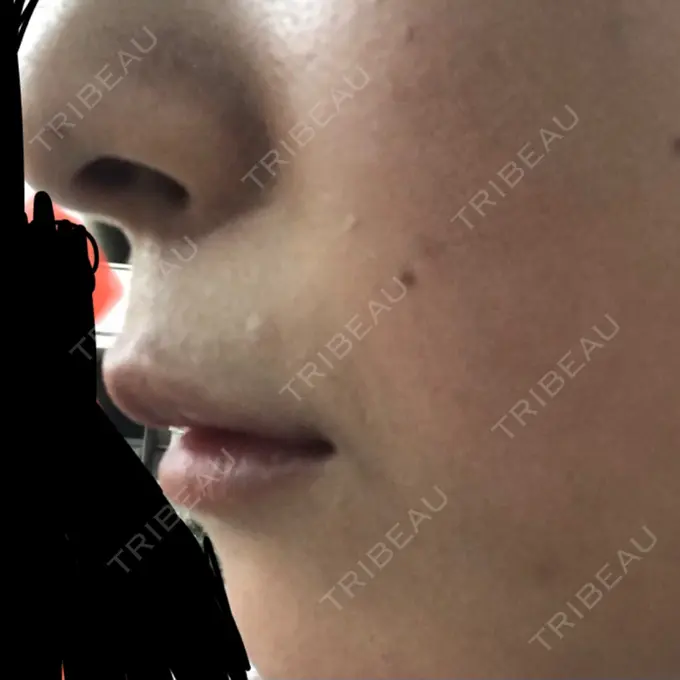 ヒアルロン酸注入（唇） LIKI CLINIC KOBE DAY 5 メイン用