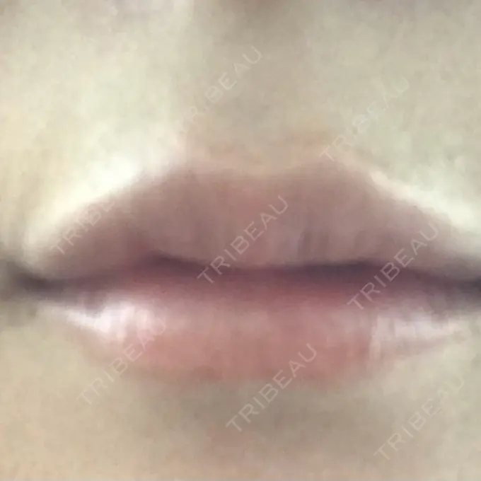 ヒアルロン酸注入（唇） LIKI CLINIC KOBE DAY 6 メイン用