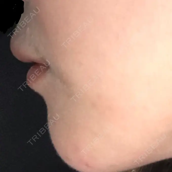 ヒアルロン酸注入（唇） LIKI CLINIC KOBE DAY 8 メイン用